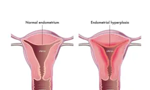 Comparaison utérus : endomètre normal vs hyperplasie de l'endomètre. L'hyperplasie peut causer fatigue et saignements.