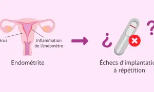 Illustration d'un utérus avec inflammation de l'endomètre, menant à des échecs d'implantation à répétition. L'endométrite chronique peut être une cause.