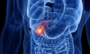 Illustration médicale montrant une vésicule biliaire enflammée, avec une zone rouge et jaune indiquant la douleur, typique des symptômes d'inflammation vésicule biliaire.