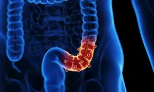 Illustration 3D du côlon humain, avec une zone rouge et enflammée, suggérant une inflammation du tractus gastro-intestinal.