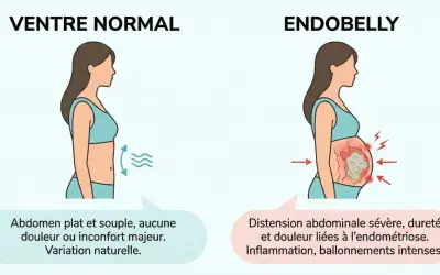 Ventre normal vs. endobelly : distension, douleur et inflammation dues à l'endométriose, affectant l'humeur.