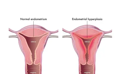 Comparaison utérus : endomètre normal vs hyperplasie de l'endomètre. L'hyperplasie peut causer fatigue et saignements.