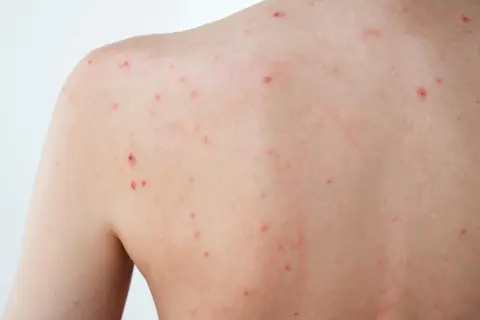 Éruption cutanée sur le dos, avec de petits points rouges, peut-être un bouton de stress.