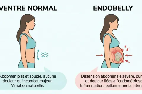 Ventre normal vs. endobelly : distension, douleur et inflammation dues à l'endométriose, affectant l'humeur.