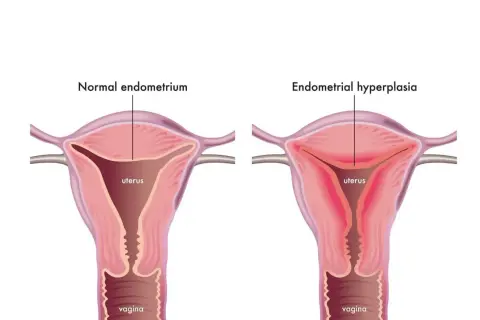 Comparaison utérus : endomètre normal vs hyperplasie de l'endomètre. L'hyperplasie peut causer fatigue et saignements.