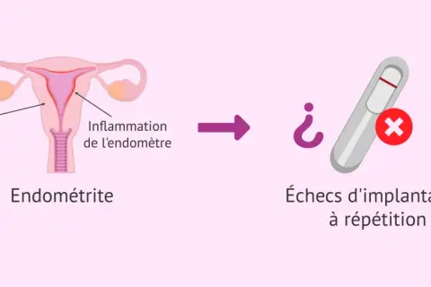 Illustration d'un utérus avec inflammation de l'endomètre, menant à des échecs d'implantation à répétition. L'endométrite chronique peut être une cause.
