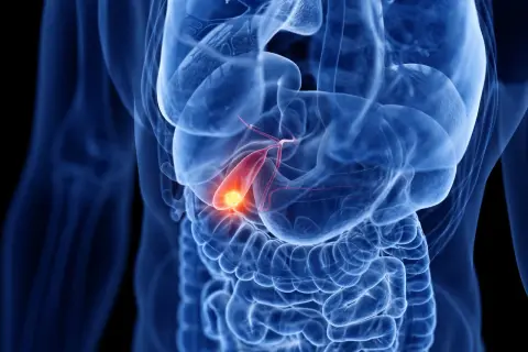 Illustration médicale montrant une vésicule biliaire enflammée, avec une zone rouge et jaune indiquant la douleur, typique des symptômes d'inflammation vésicule biliaire.