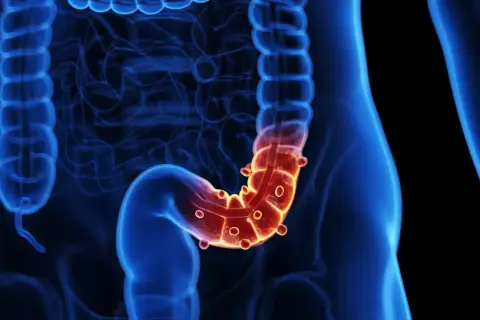 Illustration 3D du côlon humain, avec une zone rouge et enflammée, suggérant une inflammation du tractus gastro-intestinal.