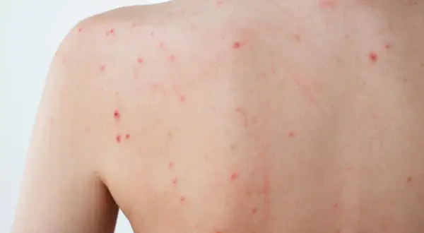 Éruption cutanée sur le dos, avec de petits points rouges, peut-être un bouton de stress.