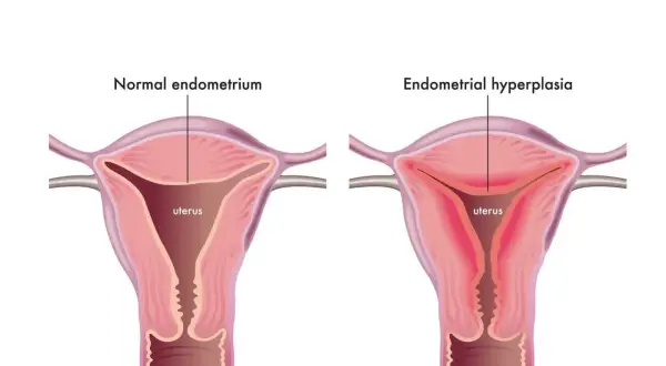 Comparaison utérus : endomètre normal vs hyperplasie de l'endomètre. L'hyperplasie peut causer fatigue et saignements.