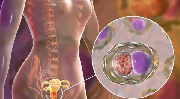 Illustration d'une femme montrant l'inflammation de l'utérus, avec un zoom sur des cellules infectées par des bactéries.