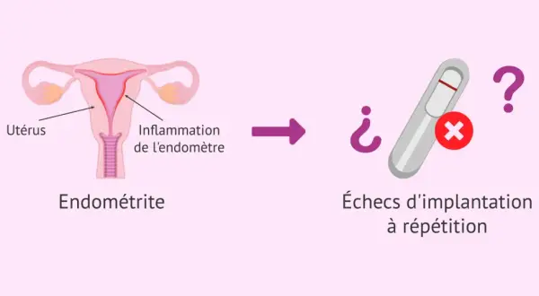 Illustration d'un utérus avec inflammation de l'endomètre, menant à des échecs d'implantation à répétition. L'endométrite chronique peut être une cause.