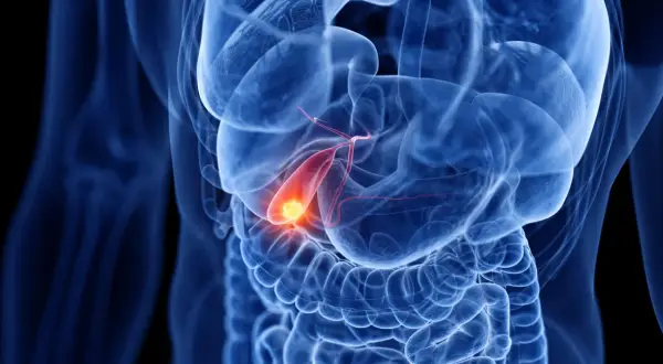 Illustration médicale montrant une vésicule biliaire enflammée, avec une zone rouge et jaune indiquant la douleur, typique des symptômes d'inflammation vésicule biliaire.