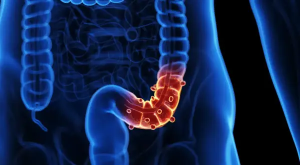 Illustration 3D du côlon humain, avec une zone rouge et enflammée, suggérant une inflammation du tractus gastro-intestinal.