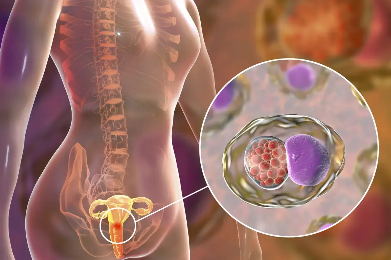 Illustration d'une femme montrant l'inflammation de l'utérus, avec un zoom sur des cellules infectées par des bactéries.