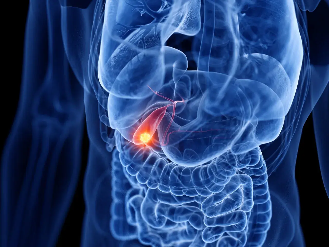Illustration médicale montrant une vésicule biliaire enflammée, avec une zone rouge et jaune indiquant la douleur, typique des symptômes d'inflammation vésicule biliaire.