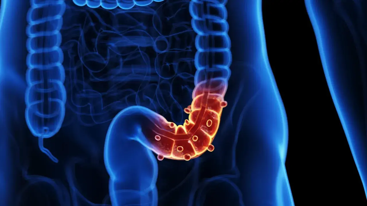 Illustration 3D du côlon humain, avec une zone rouge et enflammée, suggérant une inflammation du tractus gastro-intestinal.