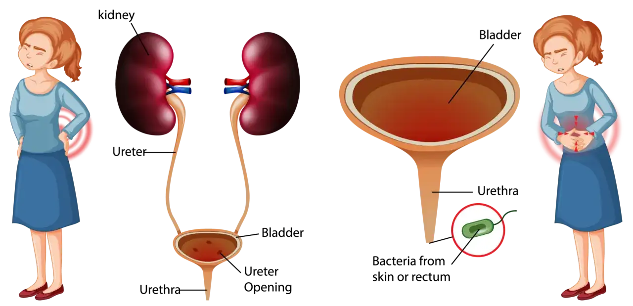 Illustration du syst&egrave;me urinaire et de femmes souffrant de douleurs abdominales, montrant les sympt&ocirc;mes d'une infection urinaire caus&eacute;e par des bact&eacute;ries.