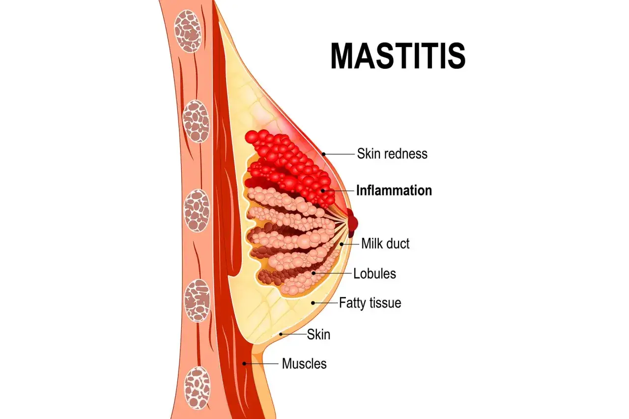 Illustration anatomique montrant la mastite infectieuse, avec rougeur cutan&eacute;e et inflammation des lobules mammaires.