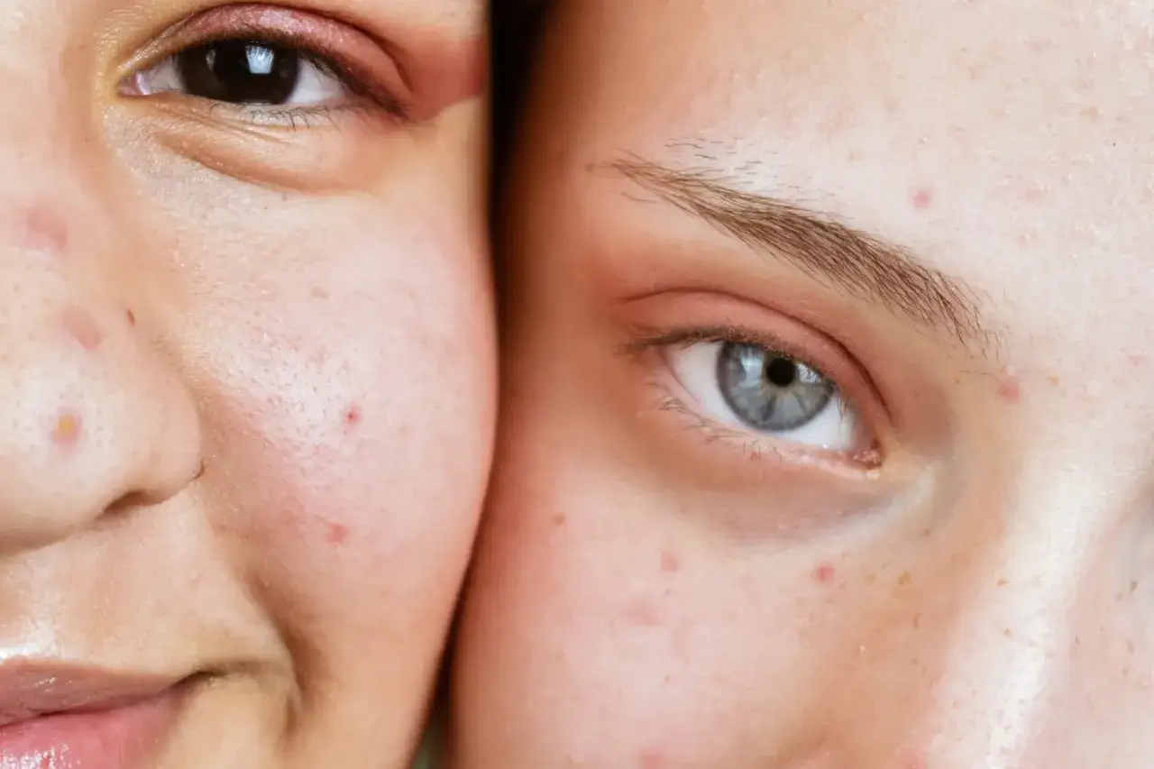 Deux visages proches, l'un avec un bouton de stress sur la joue, l'autre avec des rougeurs et des imperfections.