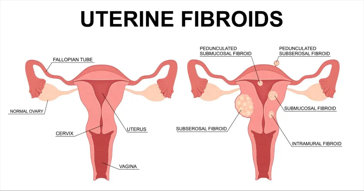 Illustration comparant un utérus normal à un utérus présentant diverses lésions : fibromes sous-muqueux, sous-séreux et intramuraux.