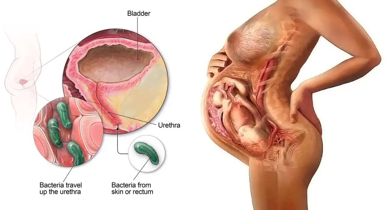 Illustration montrant comment on attrape une infection urinaire chez la femme : des bactéries remontent par l'urètre vers la vessie.