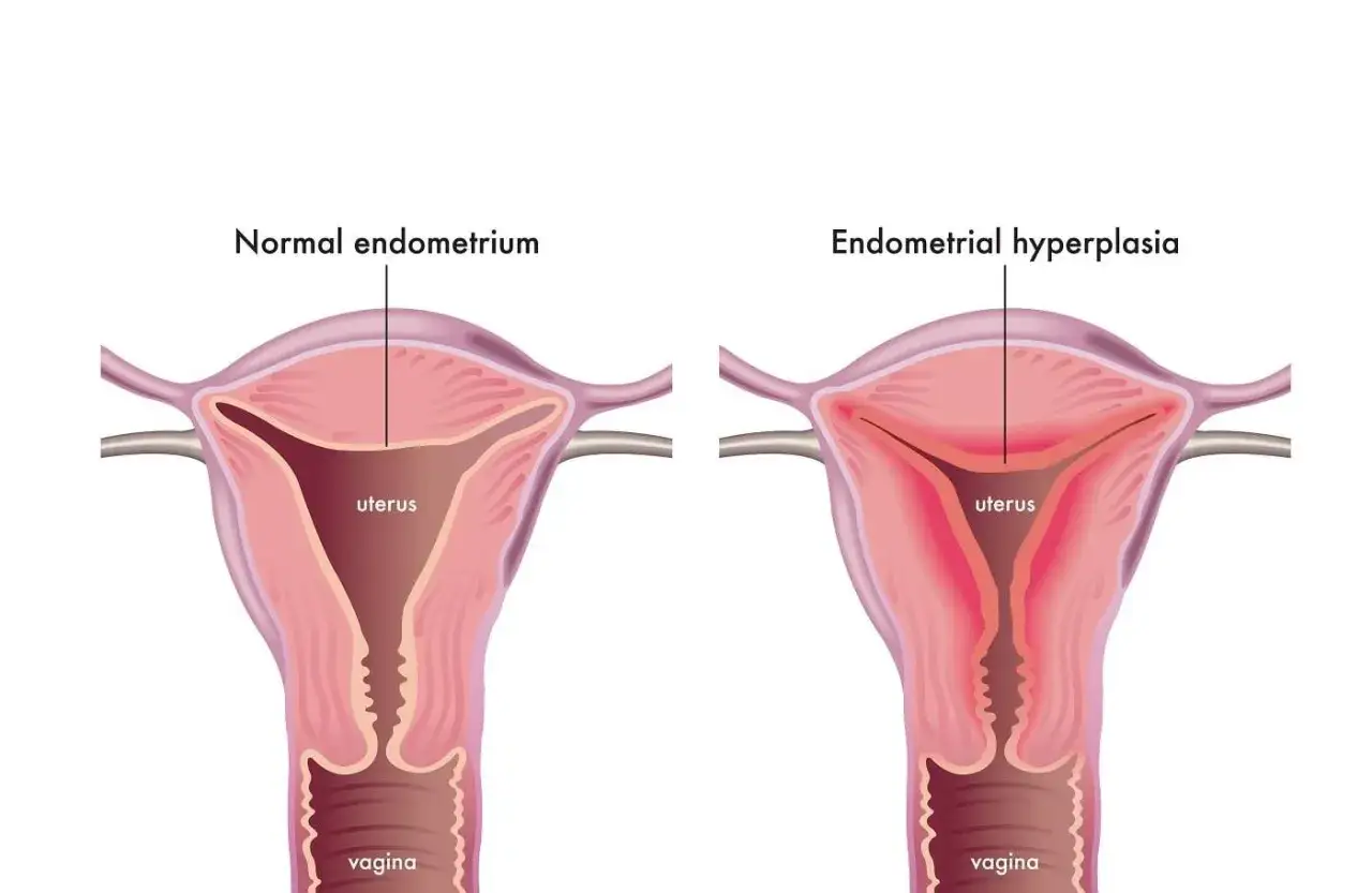 Comparaison utérus : endomètre normal vs hyperplasie de l'endomètre. L'hyperplasie peut causer fatigue et saignements.