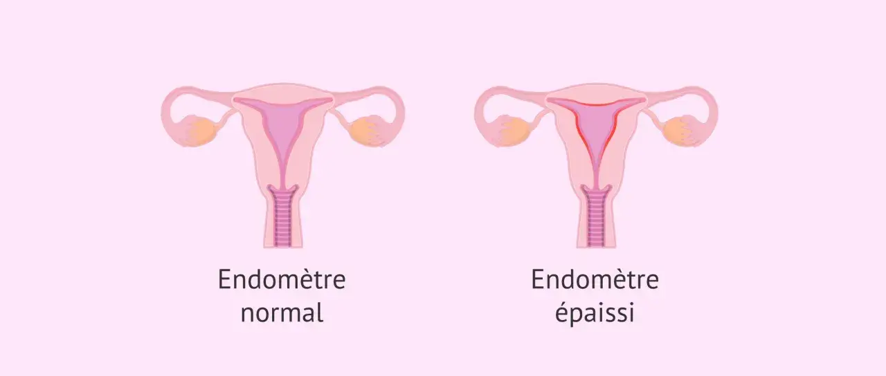 Comparaison d'un utérus avec un endomètre normal et un endomètre épaissi, pouvant indiquer une dysplasie utérus.