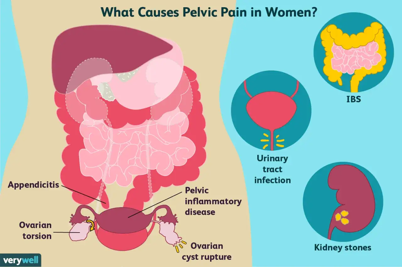 Causes de douleurs pelviennes : appendicite, torsion ovarienne, infection urinaire, maladie inflammatoire pelvienne, rupture de kyste ovarien, IBS, calculs rénaux. Voici pourquoi j'ai mal à l'ovaire.