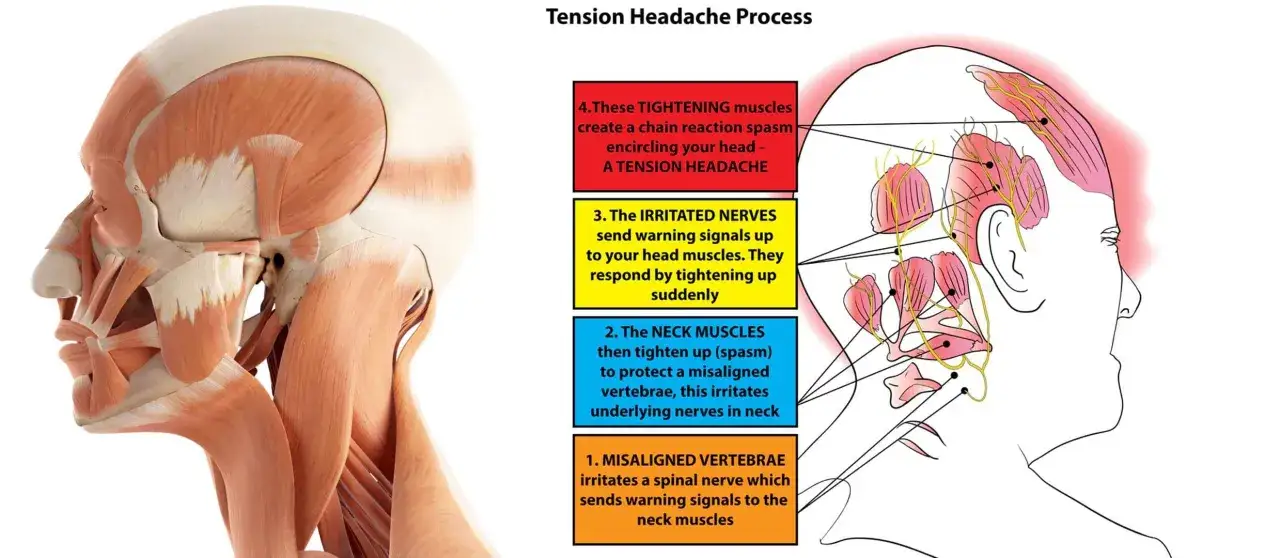 Anatomie de la t&ecirc;te et du cou expliquant le mal de t&ecirc;te tous les jours et fatigue. Les muscles tendus et les nerfs irrit&eacute;s provoquent des spasmes.