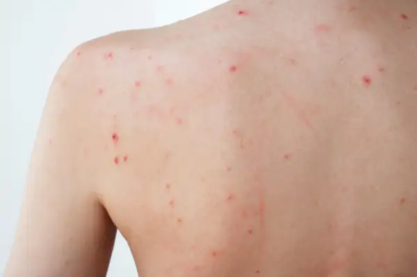 Éruption cutanée sur le dos, avec de petits points rouges, peut-être un bouton de stress.