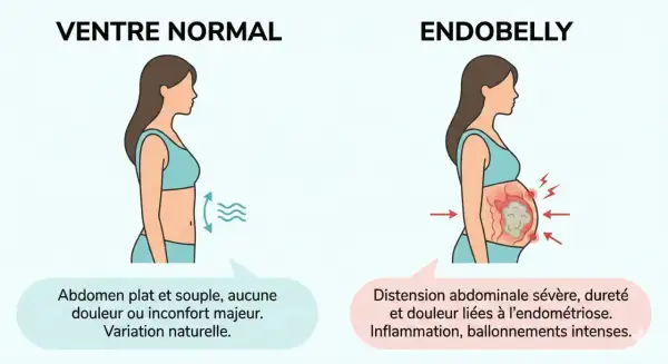 Ventre normal vs. endobelly : distension, douleur et inflammation dues à l'endométriose, affectant l'humeur.