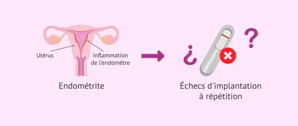 Illustration d'un utérus avec inflammation de l'endomètre, menant à des échecs d'implantation à répétition. L'endométrite chronique peut être une cause.
