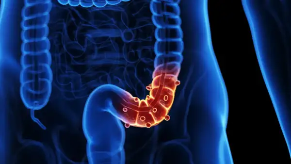 Illustration 3D du côlon humain, avec une zone rouge et enflammée, suggérant une inflammation du tractus gastro-intestinal.